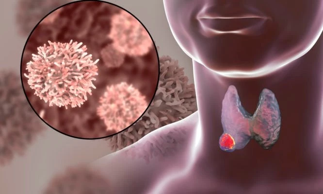 Σήμα κινδύνου από επιστήμονες: Υπερδιπλασιάστηκαν παγκοσμίως τα κρούσματα καρκίνου του θυρεοειδούς